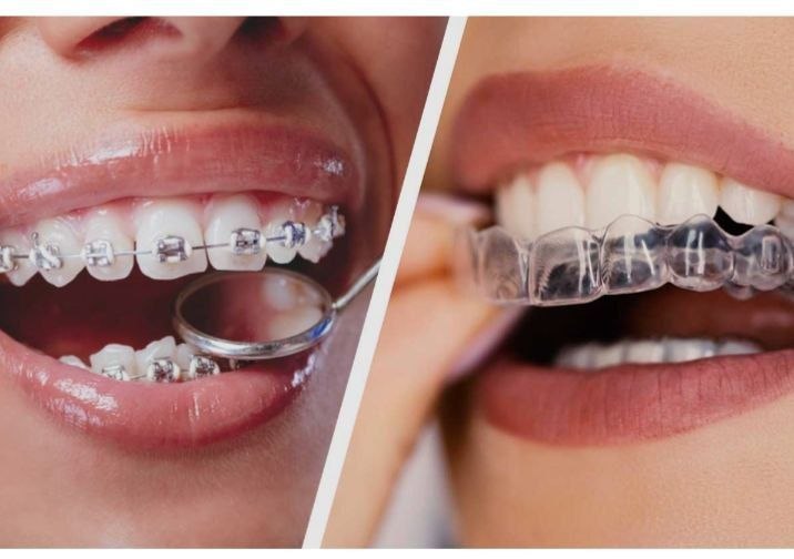 Braces & Invisalign