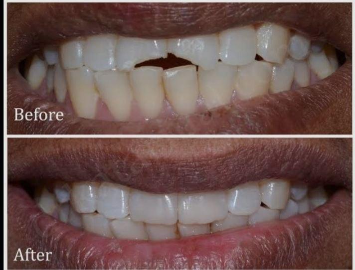 Tooth Restoration