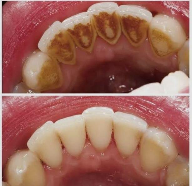Tooth Scaling & Cleaning