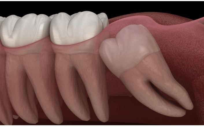 Minor Oral Surgeries